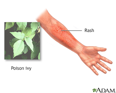 poison ivy plants pictures. Poison ivy can be found in